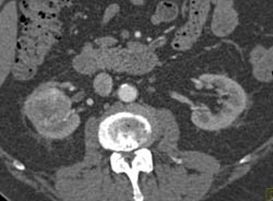 Renal Cell Carcinoma - CTisus CT Scan