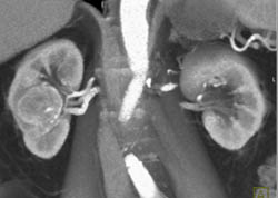 Renal Cell Carcinoma - CTisus CT Scan