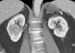 Renal Cell Carcinoma - CTisus CT Scan