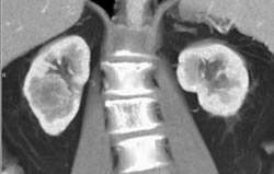 Renal Cell Carcinoma - CTisus CT Scan