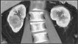 Renal Cell Carcinoma - CTisus CT Scan