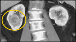 Renal Cell Carcinoma - CTisus CT Scan