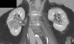 Renal Cell Carcinoma - CTisus CT Scan