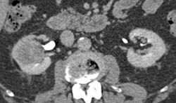 Renal Cell Carcinoma - CTisus CT Scan