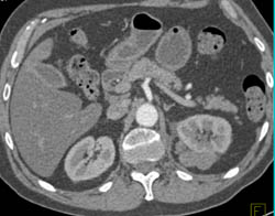 Peri-renal Lymphoma - CTisus CT Scan