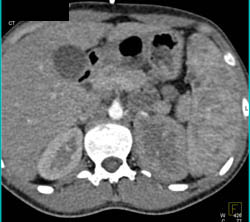 Acute Pyelonephritis - CTisus CT Scan