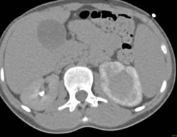 Acute Pyelonephritis - CTisus CT Scan