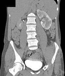 Acute Pyelonephritis - CTisus CT Scan