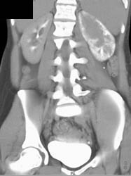 Acute Pyelonephritis - CTisus CT Scan