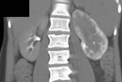 Acute Pyelonephritis - CTisus CT Scan