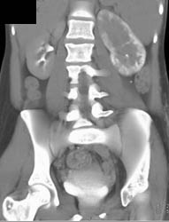 Acute Pyelonephritis - CTisus CT Scan