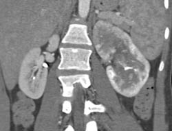 Acute Pyelonephritis - CTisus CT Scan