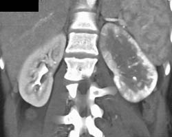 Acute Pyelonephritis - CTisus CT Scan