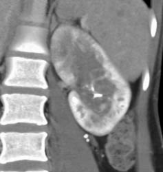 Acute Pyelonephritis - CTisus CT Scan