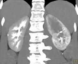 Acute Pyelonephritis - CTisus CT Scan