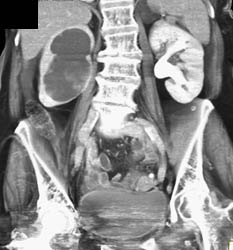 Ureteropelvic Junction (UPJ) Right Kidney Due to Transitional Cell Carcinoma - CTisus CT Scan