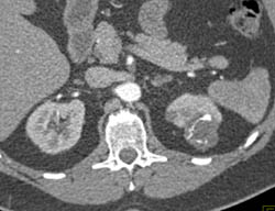 Cystic Renal Cell Carcinoma - CTisus CT Scan