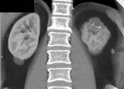 Cystic Renal Cell Carcinoma - CTisus CT Scan