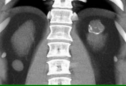 Cystic Renal Cell Carcinoma - CTisus CT Scan