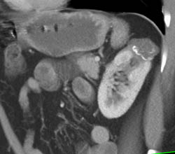 Cystic Renal Cell Carcinoma - CTisus CT Scan