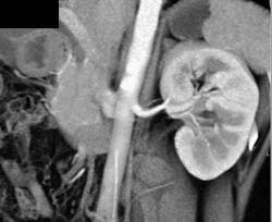 Recurrent Tumor Renal Bed - CTisus CT Scan