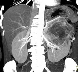 Renal Cell Carcinoma - CTisus CT Scan