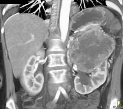 Renal Cell Carcinoma - CTisus CT Scan