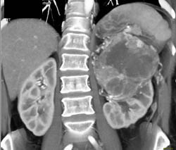 Renal Cell Carcinoma - CTisus CT Scan