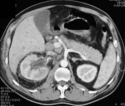 Transitional Cell Carcinoma With Pericardial Nodes and Tumor in Right Psoas Muscle and Right Lower Quadrant - CTisus CT Scan