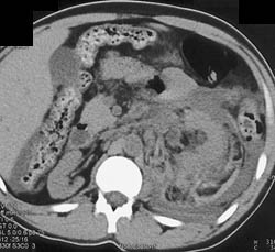 Left Perirenal Hematoma - CTisus CT Scan