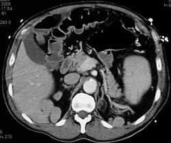 Splenosis in Renal Beds - CTisus CT Scan