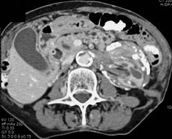 Retroperitoneal Fibrosis - CTisus CT Scan