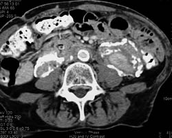 Retroperitoneal Fibrosis - CTisus CT Scan