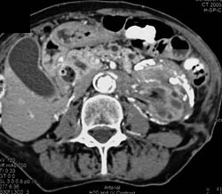 Retroperitoneal Fibrosis - CTisus CT Scan