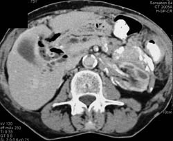 Retroperitoneal Fibrosis - CTisus CT Scan