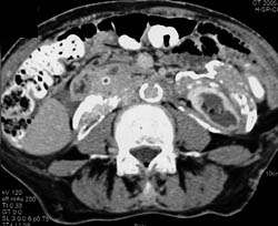 Retroperitoneal Fibrosis - CTisus CT Scan