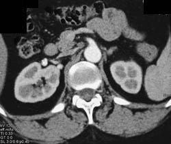 Right Renal Artery Aneurysm - CTisus CT Scan