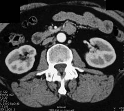 Right Renal Artery Aneurysm - CTisus CT Scan