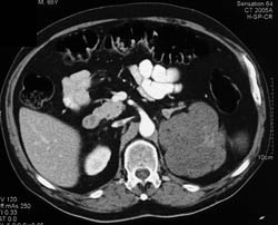 Renal Lymphoma - CTisus CT Scan