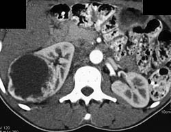 Renal Cell Carcinoma - CTisus CT Scan