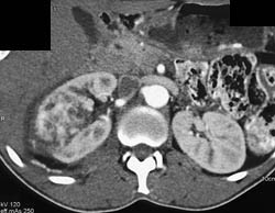 Renal Cell Carcinoma - CTisus CT Scan