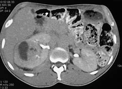 Renal Cell Carcinoma - CTisus CT Scan