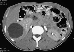 Renal Cell Carcinoma - CTisus CT Scan