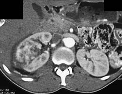 Renal Cell Carcinoma - CTisus CT Scan