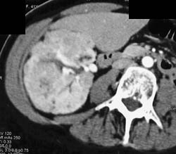 Multiple Right Renal Angiomyelolipomas - CTisus CT Scan