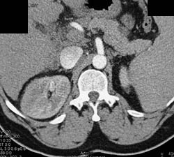 Acute Pyelonephritis - CTisus CT Scan