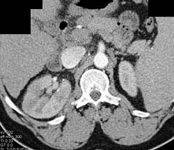 Acute Pyelonephritis - CTisus CT Scan