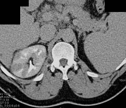 Acute Pyelonephritis - CTisus CT Scan