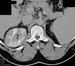 Acute Pyelonephritis - CTisus CT Scan