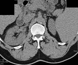 Acute Pyelonephritis - CTisus CT Scan